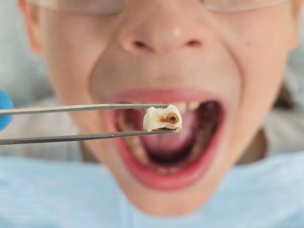Best Emergency Root Canal Therapy in Marlette, MI